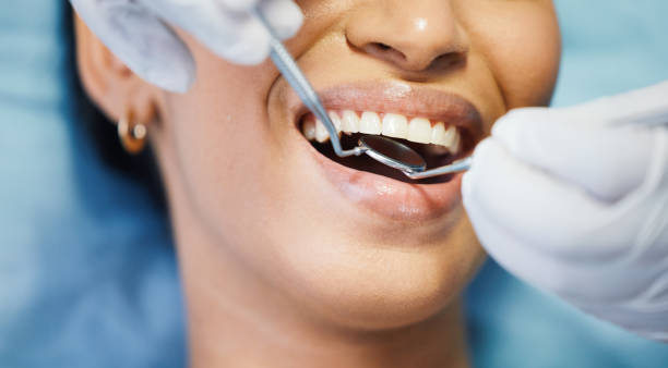 Best Knocked-Out Tooth (Avulsed Tooth) Treatment in Seabrook, TX
